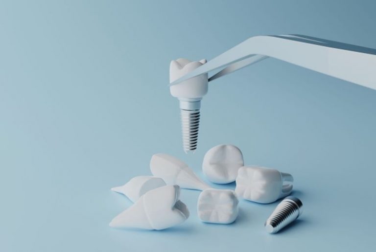 Kako pomagajo implantati pri izgubi zob